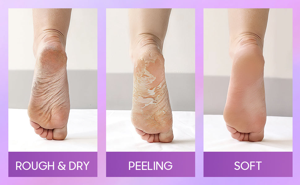 SoleSilk™ | Exfoliating Foot Mask